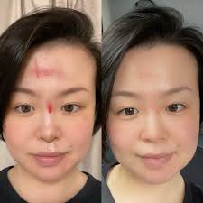 Red Light Therapy Before and After